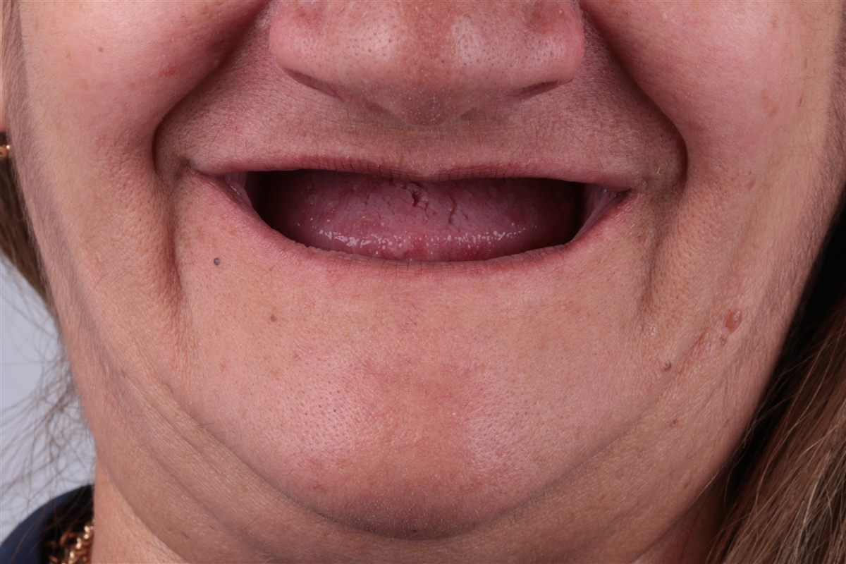 Rostro frontal de paciente con pérdida de piezas dentales